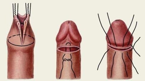 Como se realiza a cirurxía plástica do pene